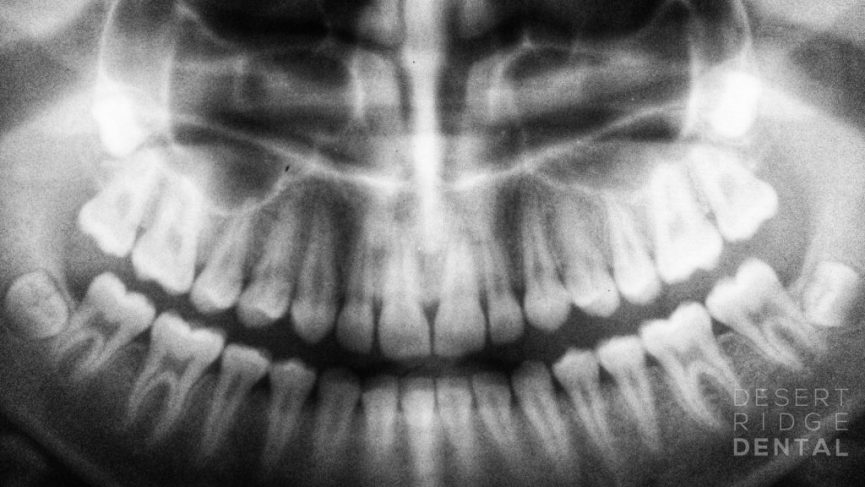 an X-ray of a human mouth, showing a detailed view of teeth, jawbone, and sinus structures. The image is black and white, with the teeth appearing prominently against the darker background. The logo "DESERT RIDGE DENTAL" is positioned in the lower right corner.