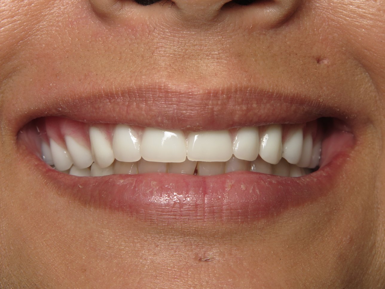Patient's mouth after dental implants.